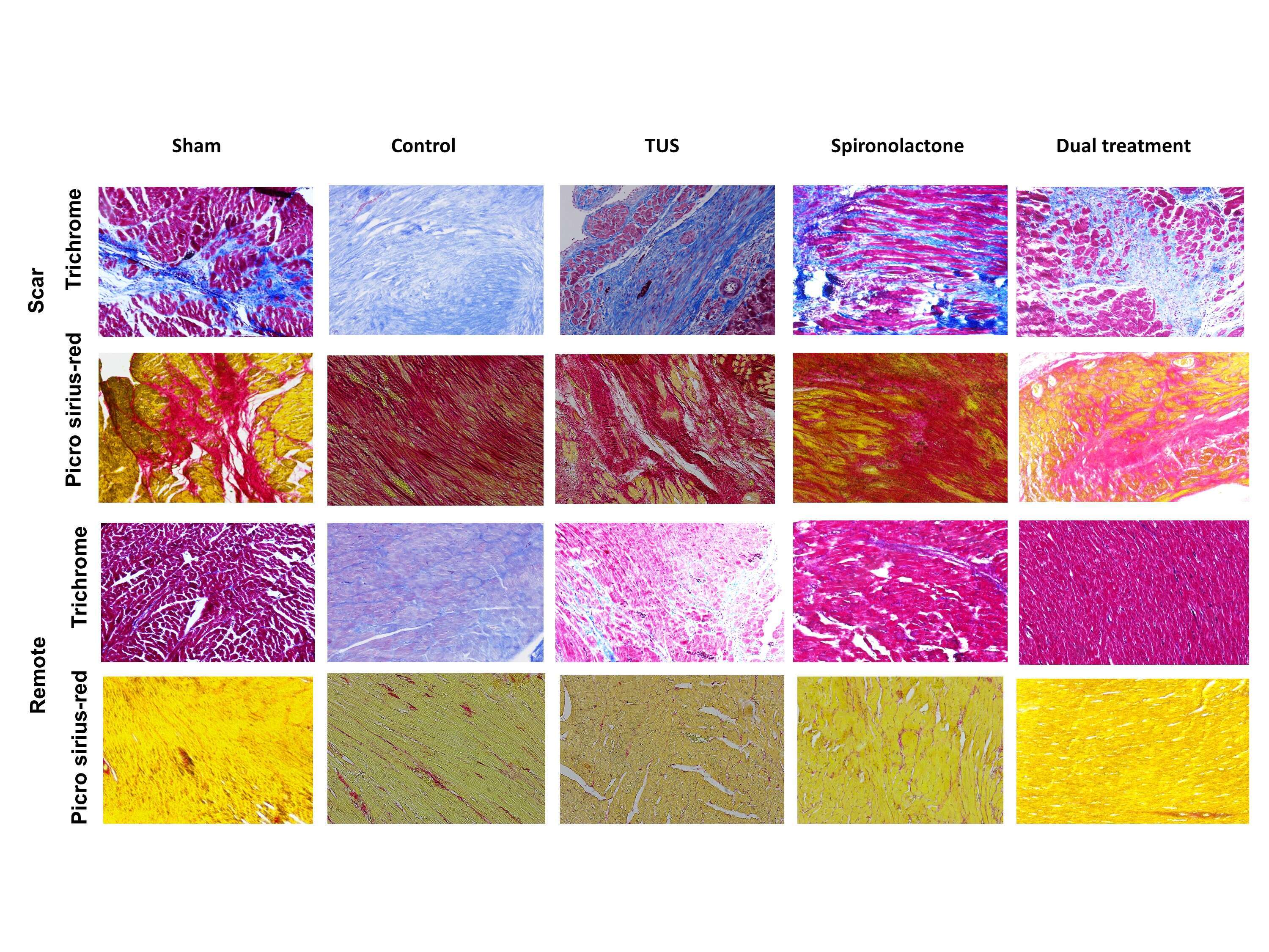 Figure 1: Representative histological specimens of cardiac muscles stained with Tri-chrome Masson`s (first and third rows), and Picro-Sirius red stain (second and fourth rows). Specimens in the first 2 rows were taken from scar areas, and the lower 2 rows were taken from remote areas. Each column represents the designated treatment. (X10 magnification).
